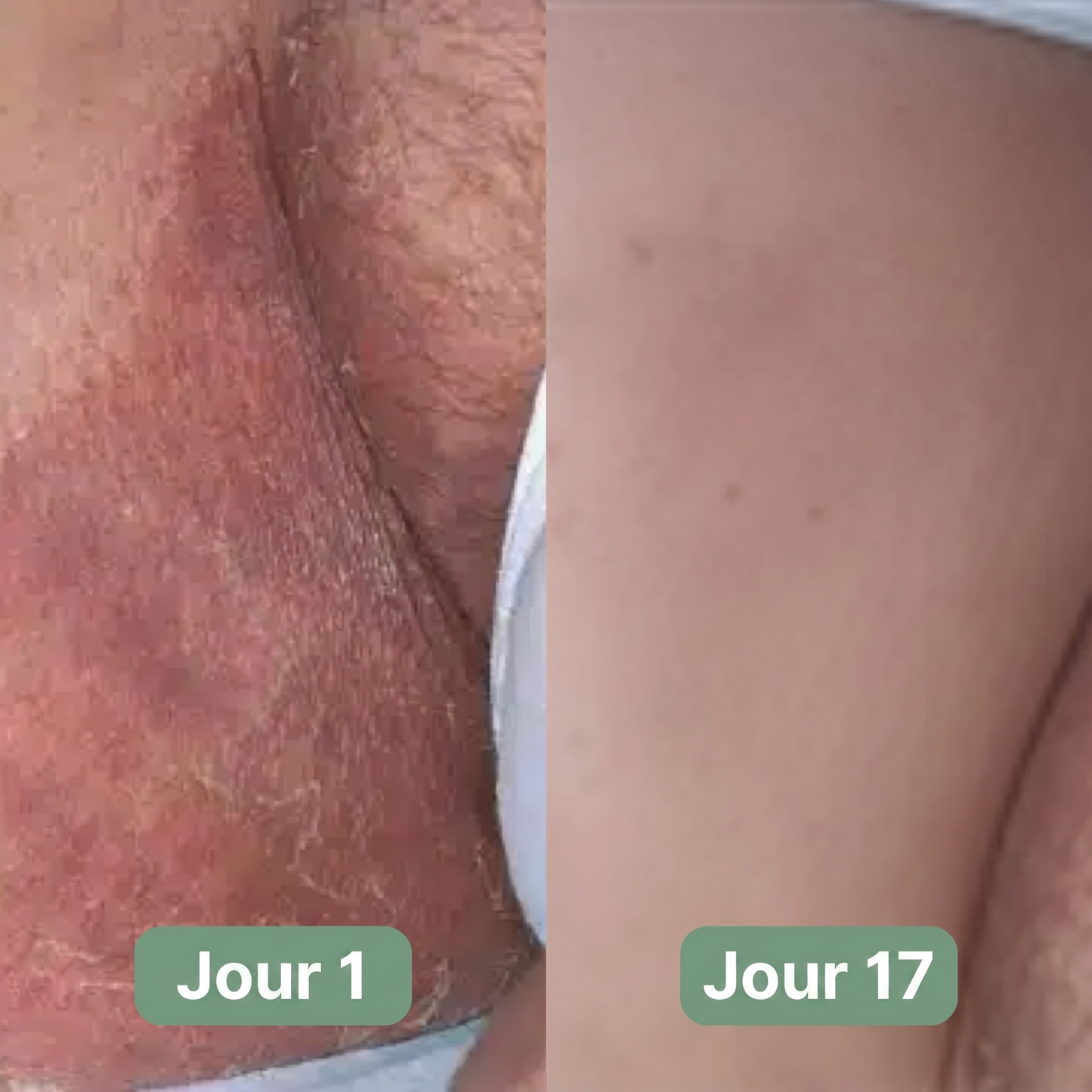 Onela® Savon Antifongique
